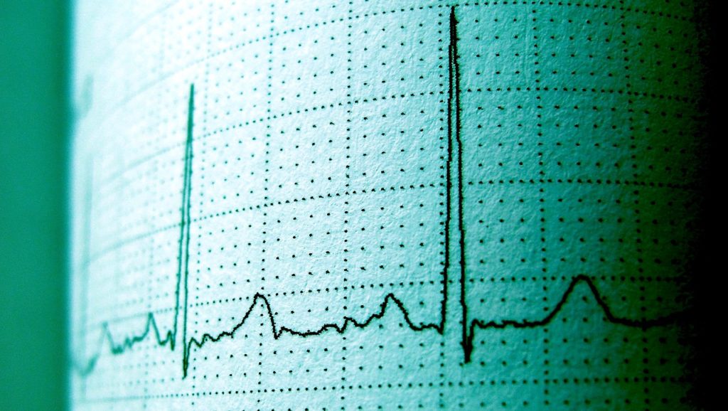 A printed readout of an EKG or electrocardiogram