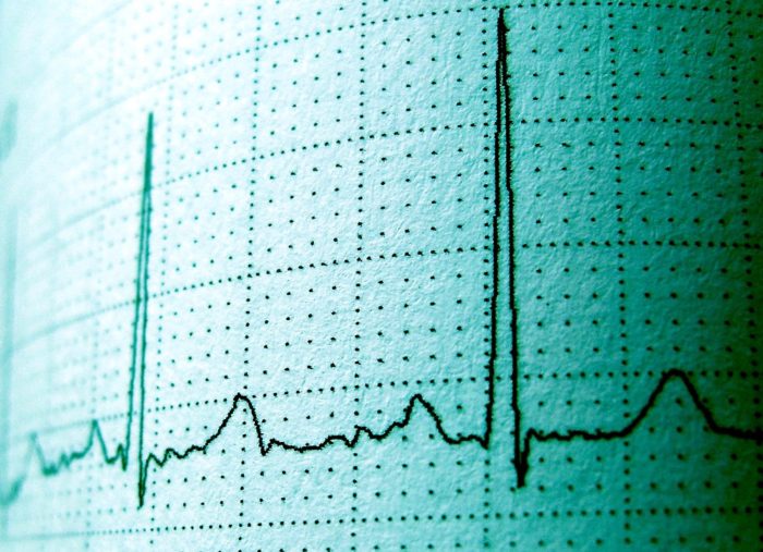 EKG Essentials